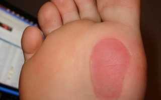 Причины жжения в стопах ног