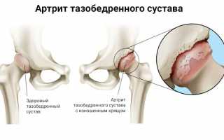 Артрит тазобедренного сустава