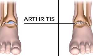Артрит нижних конечностей