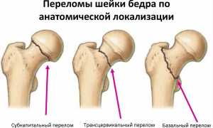 Перелом шейки бедра в пожилом возрасте