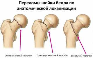 Перелом шейки бедра в пожилом возрасте