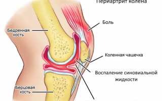 Периартрит коленного сустава симптомы и лечение