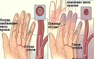 Болезнь (синдром) Рейно: диагностика и способы лечения сосудов