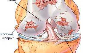 Восстановление суставного хряща