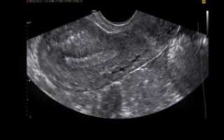 Толщина эндометрия для зачатия: норма для овуляции и беременности