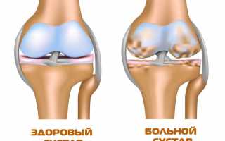 Лечение артроза коленного сустава 3 степени