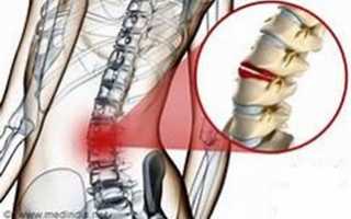 Компрессионный перелом позвоночника у детей