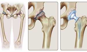 Лечение коксартроза тазобедренного сустава 4 степени