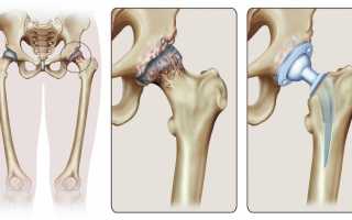 Лечение коксартроза тазобедренного сустава 4 степени