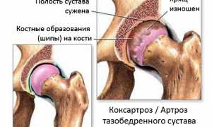 Коксартроз тазобедренного сустава симптомы и лечение