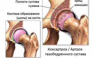 Коксартроз тазобедренного сустава симптомы и лечение