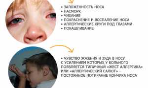 Аллергический насморк: симптомы у детей, причины, лечение дома