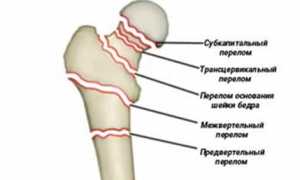 Чрезвертельный перелом бедра