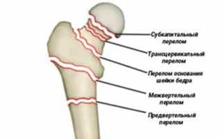 Чрезвертельный перелом бедра