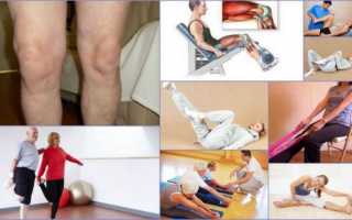 ЛФК при гонартрозе коленного сустава 3 степени