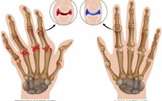 Остеоартроз кистей рук