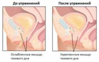 Занятия спортом при гиперплазии эндометрия: рекомендации и противопоказания
