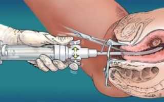 Круговая биопсия шейки матки: показания, как проводится, стоимость