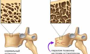 Гимнастика при остеопорозе