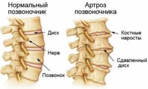 Остеоартроз позвоночника