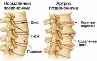 Остеоартроз позвоночника