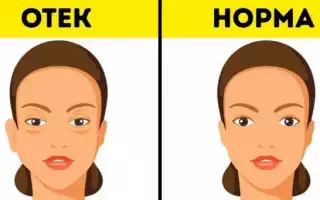 Как снять отечность после застолья? Практические рекомедации