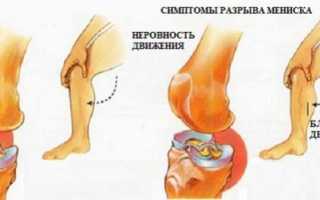 Лечение разрыва мениска колена без операции
