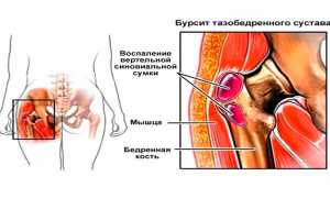 Несколько слов о бурсите тазобедренного сустава