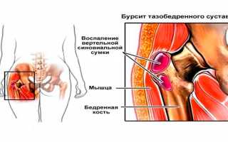 Несколько слов о бурсите тазобедренного сустава