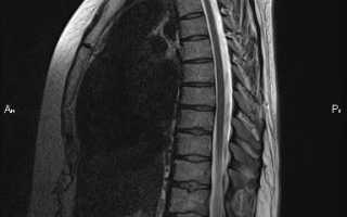МРТ грудного отдела позвоночника
