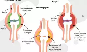 Серопозитивный ревматоидный артрит