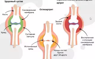 Серопозитивный ревматоидный артрит