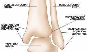 Перелом голеностопного сустава