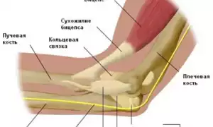 Контрактура локтевого сустава