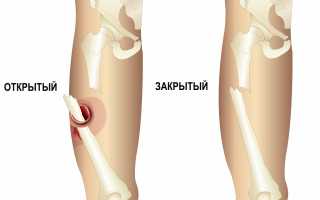 Перелом кости