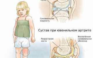 Ревматоидный артрит у детей