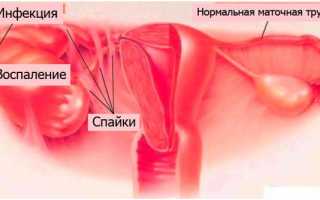 Латеропозиция матки: причины возникновения и лечение