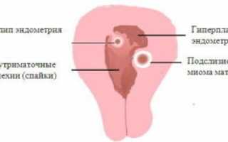 Лечение гиперплазии эндометрия с помощью гомеопатических препаратов