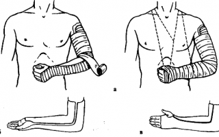 Лонгетная повязка при переломе плечевой кости