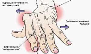 Артрит кистей рук