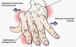 Артрит кистей рук