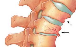 Компрессионный перелом позвоночника