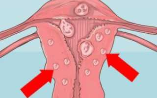 Что такое фиброиды матки?