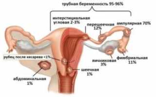 Виды выделений при внематочной беременности