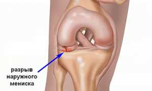 Мениск — амортизатор колена