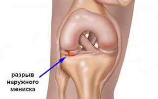 Мениск — амортизатор колена