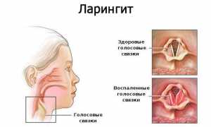 Причины сухого кашля