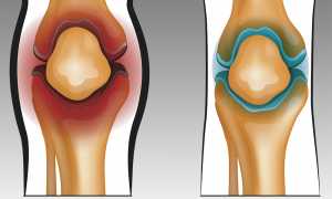Синовит при артрозе коленного сустава