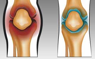 Синовит при артрозе коленного сустава