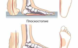 Как вылечить плоскостопие?